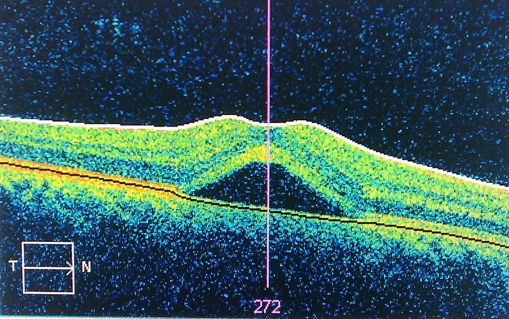 Optical Coherence Tomography (OCT) 